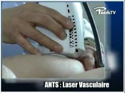The Vascular Laser : Exotherme™
