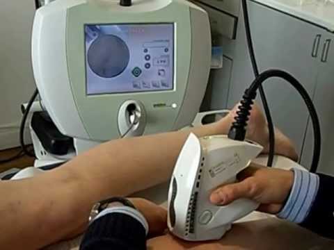Vascular laser treatment with Exotherme™