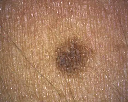 Spot-parallel-polarised